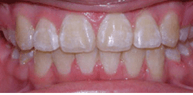 Dr. Sokoloff’s Patient After Teeth
