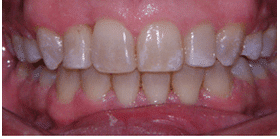 Dr. Sokoloff’s Patient After Teeth