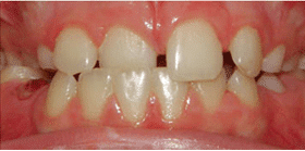 Dr. Sokoloff’s Patient Before Teeth