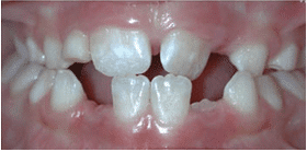 Dr. Sokoloff’s Patient Before Teeth