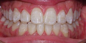 Anterior Occlusion after orthodontist white plains
