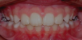 anterior collusion after orthodontist white plains ny