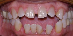 orthodontist white plains before
