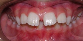 anterior collusion before orthodontist white plains ny