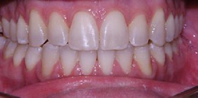 orthodontist white plains ny Anterior Occlusion after
