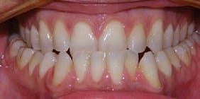 orthodontist white plains ny Anterior Occlusion before