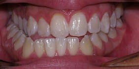 orthodontist white plains ny Anterior Occlusion before