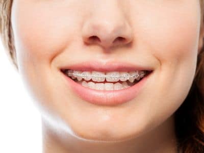 Affordable Clear Braces Near Me - Michael Sokoloff Orthodontics