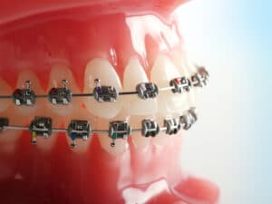 What's the Ideal Age for Orthodontic Treatment?