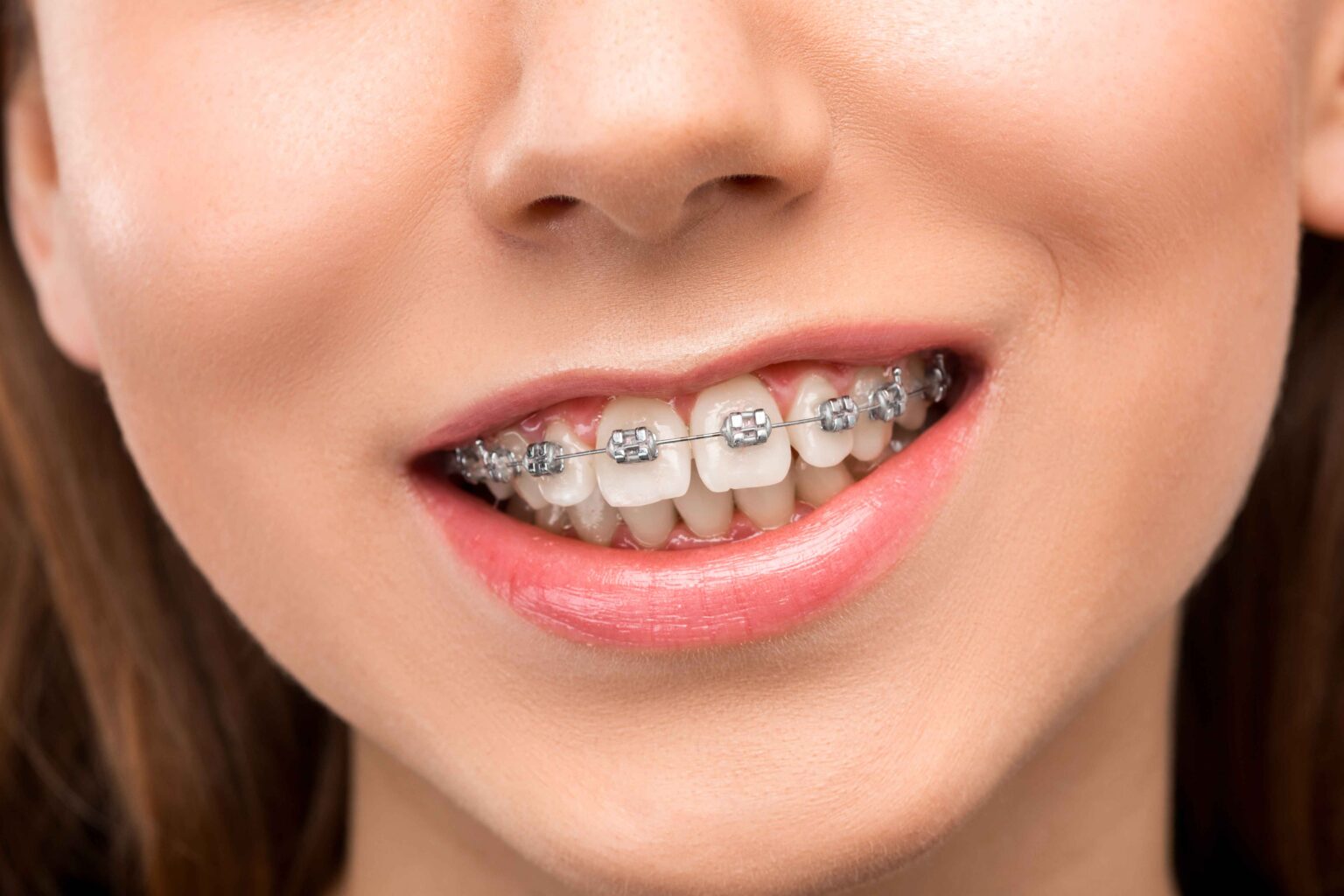 Braces in White Plains Where to Go Sokoloff Orthodontics