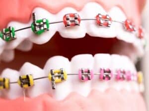 Braces Cost in White Plains