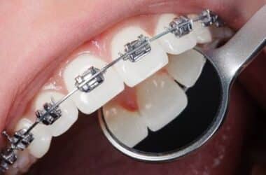 Braces Cost in White Plains