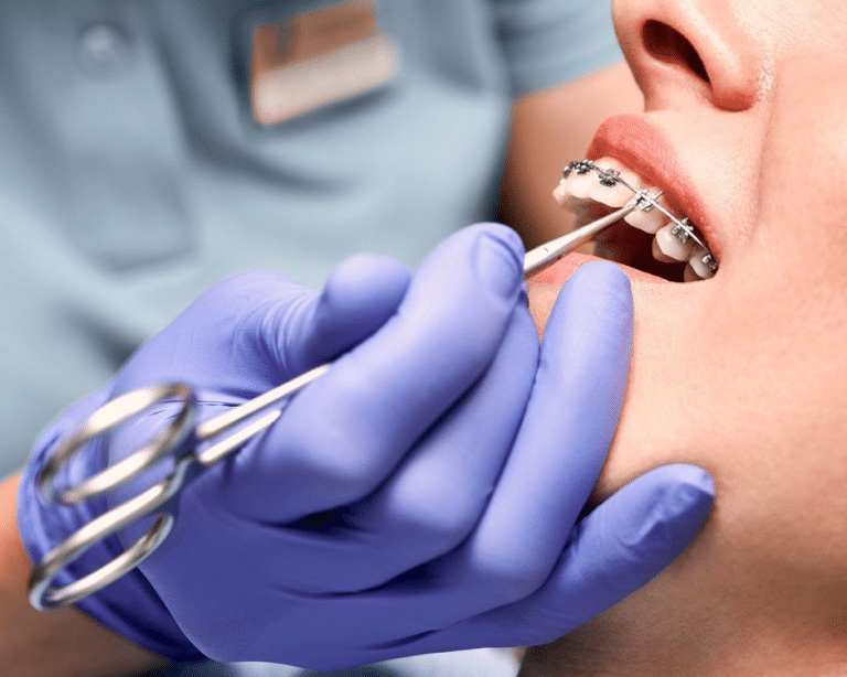 How to whiten teeth with braces