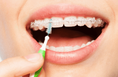 cleaning food from braces with interdental brush