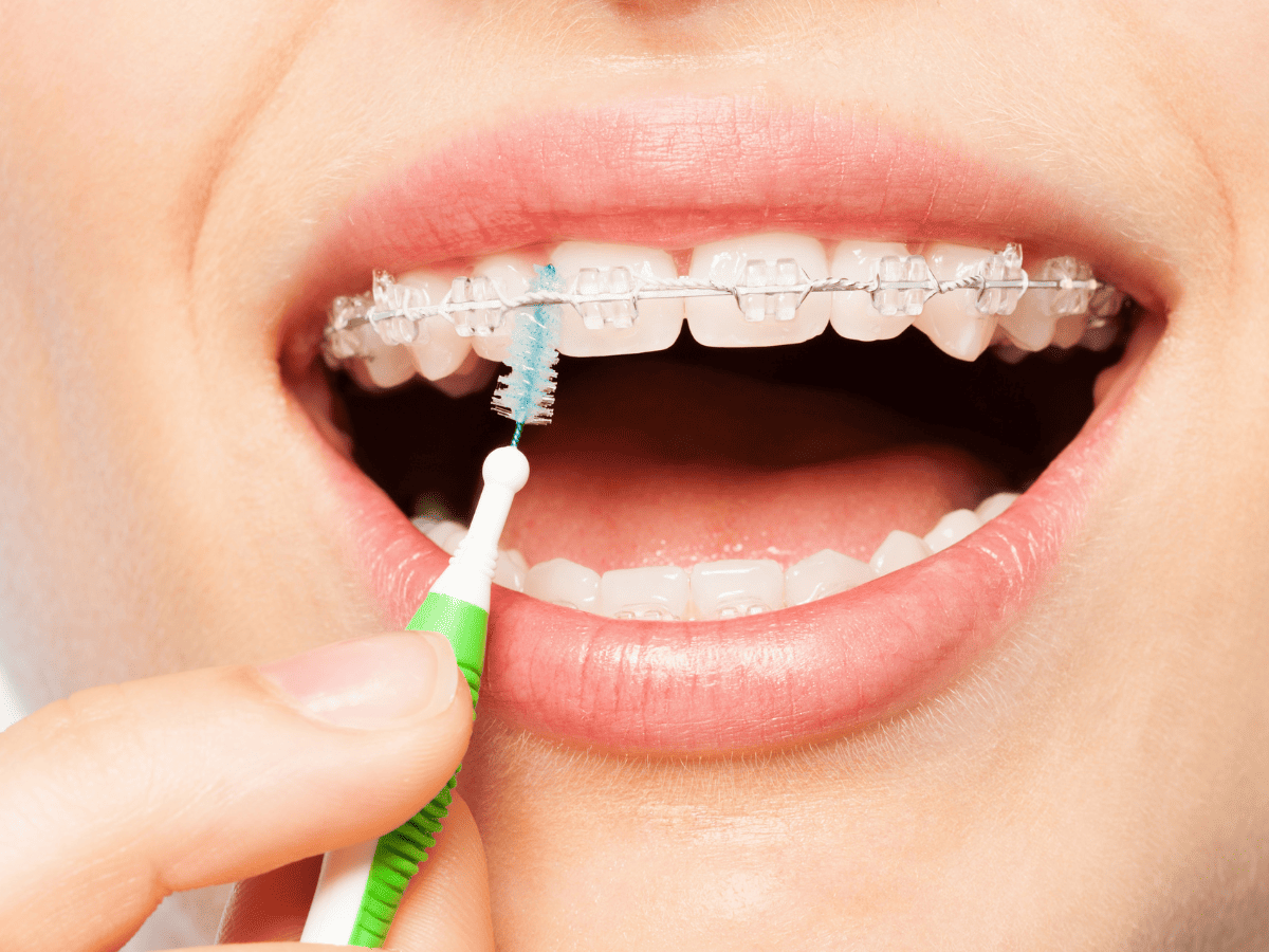 cleaning food from braces with interdental brush
