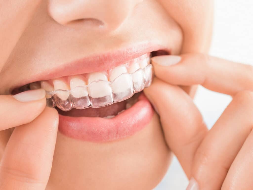 Tips to Wear Invisalign