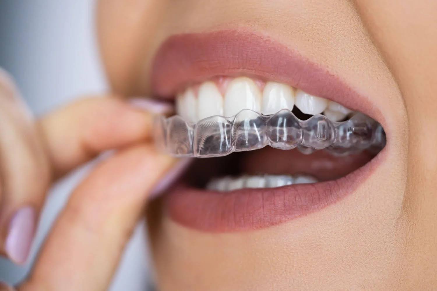 clear aligners for bite correction