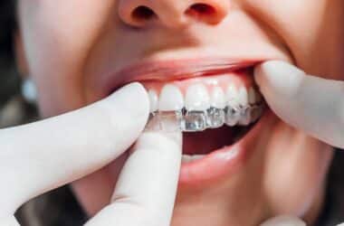 Invisalign for underbite