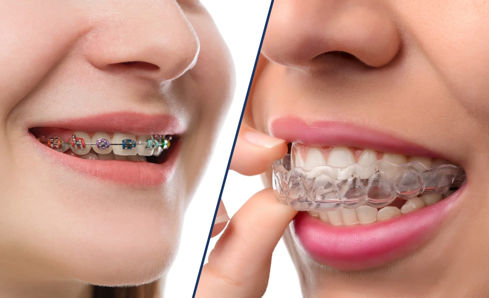 Teen orthodontic treatment