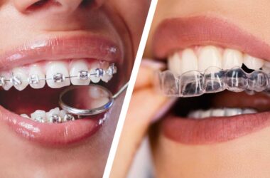 Invisalign Teen treatment