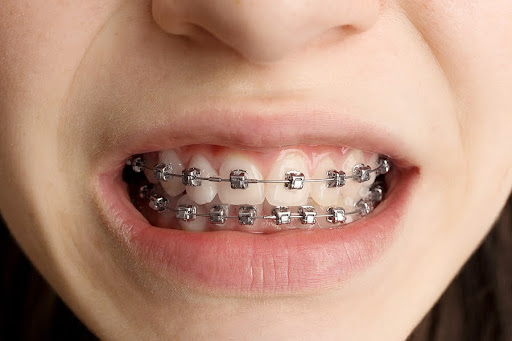 braces pain first week experience