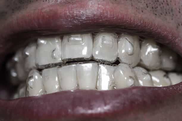 Invisalign attachments on teeth close up