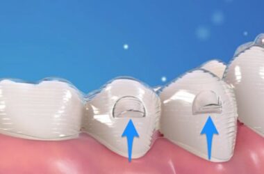 What are invisalign attachments aligners