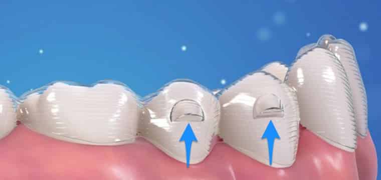 What are invisalign attachments aligners